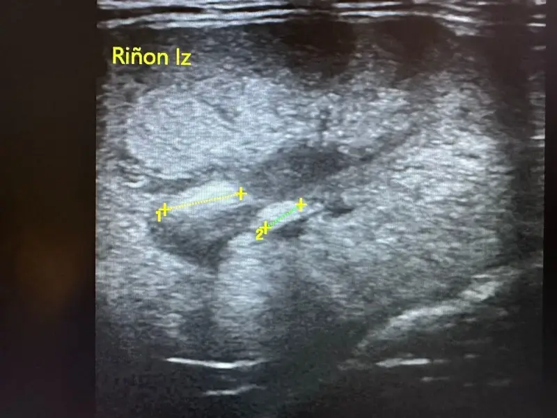 Nefrolitiasis y pielonefritis
